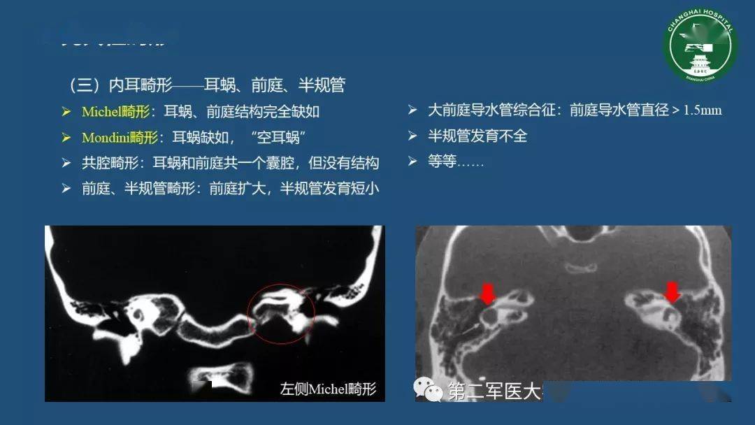 顳骨斷層解剖與CT三維重建 醫(yī)學(xué)三維分析的臨床價(jià)值